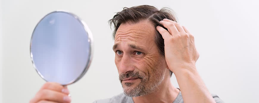 Alopecia: tipos y causas, ¿hay esperanza?