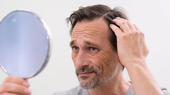 Alopecia: tipos y causas, ¿hay esperanza?